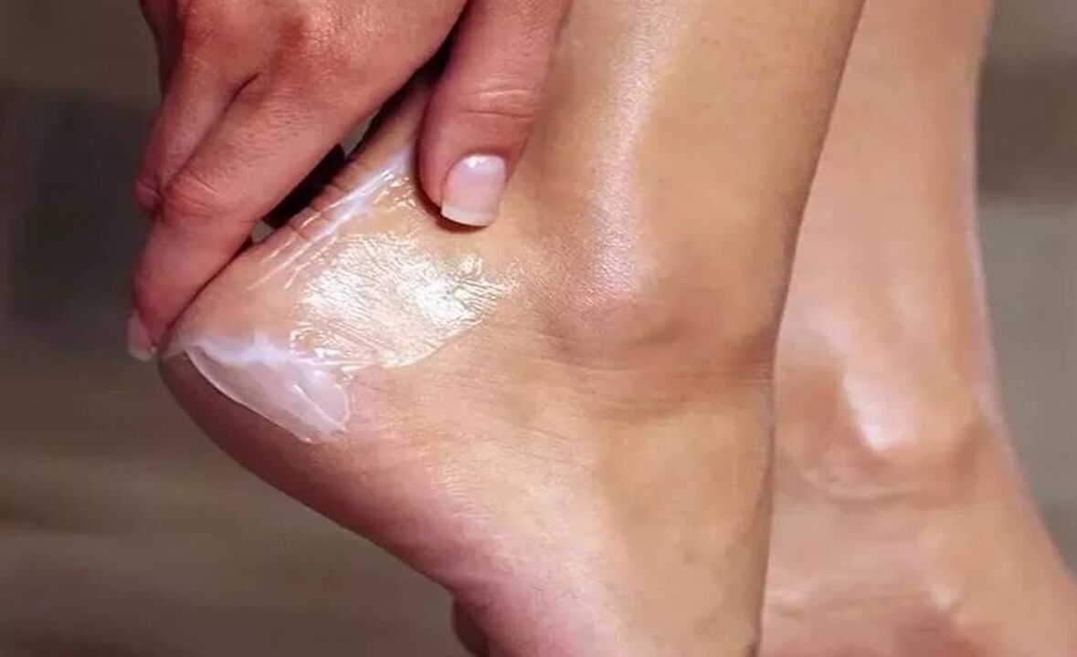 Como tratar o fungo do pé con crema funxente