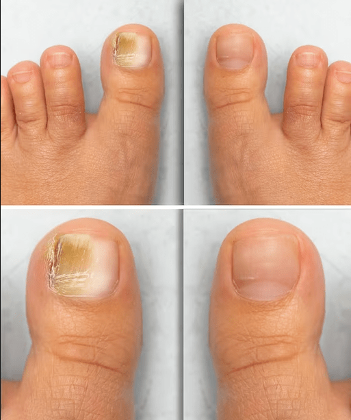 Fungo de pés antes e despois do tratamento con crema de funxes