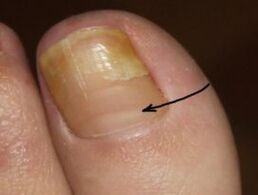 Como recoñecer a presenza dun fungo das uñas no dedo pulgar da perna