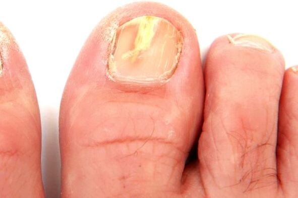 danos na placa ungueal debido a unha infección por fungos