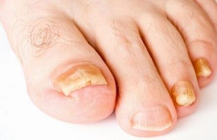 amarela das uñas dos pés debido a fungos