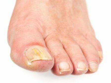 danos por fungos nas unhas