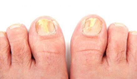 manifestacións de fungos nas unhas dos pés