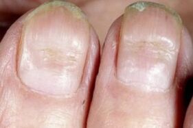 síntomas de fungo nas uñas