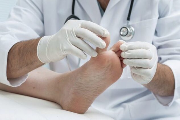 diagnóstico de fungo no pé por un médico