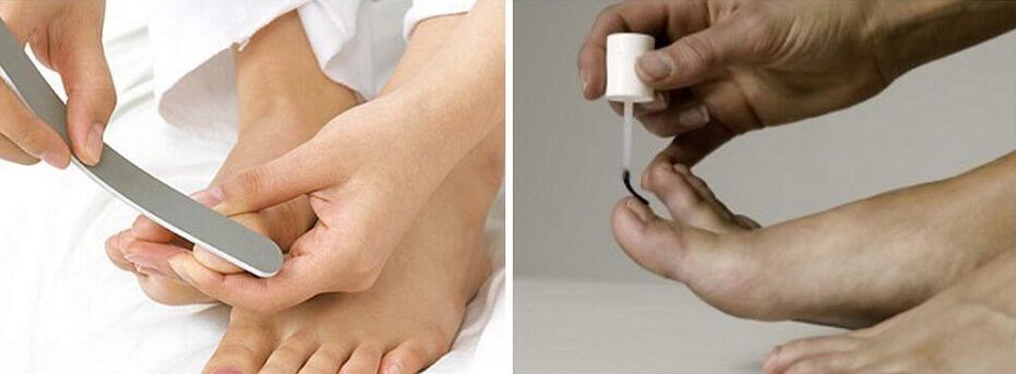 tratamento de fungos nas unhas dos pés con verniz